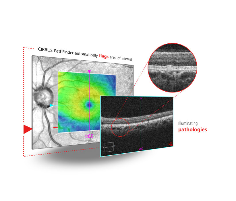 Vorschaubild von ZEISS CIRRUS PathFinder AI-Tool