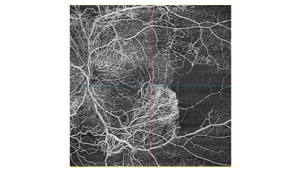 Preview image of ZEISS AngioPlex OCT Angiography