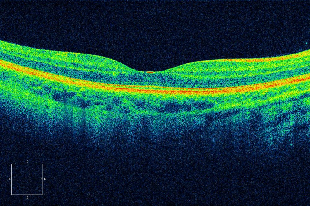 Preview image of OCT retina scan 