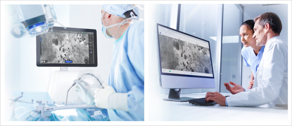 Vorschaubild von Die In Vivo Pathology Suite CONVIVO® von ZEISS überträgt intraoperativ gewonnene konfokale Bilder von Gewebefeinstrukturen zum Neuropathologen und ermöglicht eine Echtzeit Unterstützung des Chirurgen während der OP.