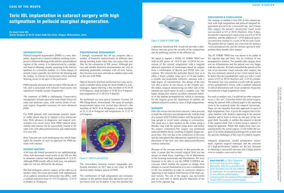 Anteprima immagine di Astigmatism Management Case of the Month Anant Gade 08-19 EN