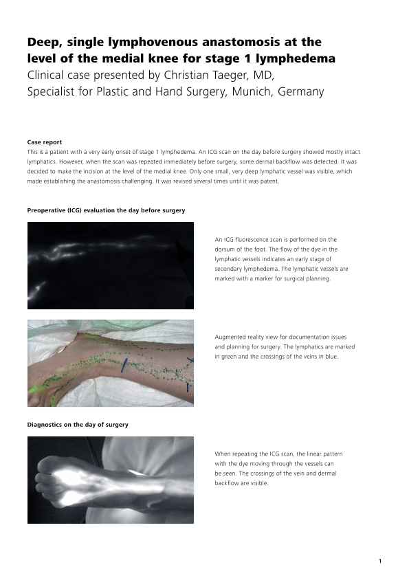 Preview image of Case report 2 - Single LVA case including revision with ZEISS PENTERO 800 S - Christian Taeger, MD