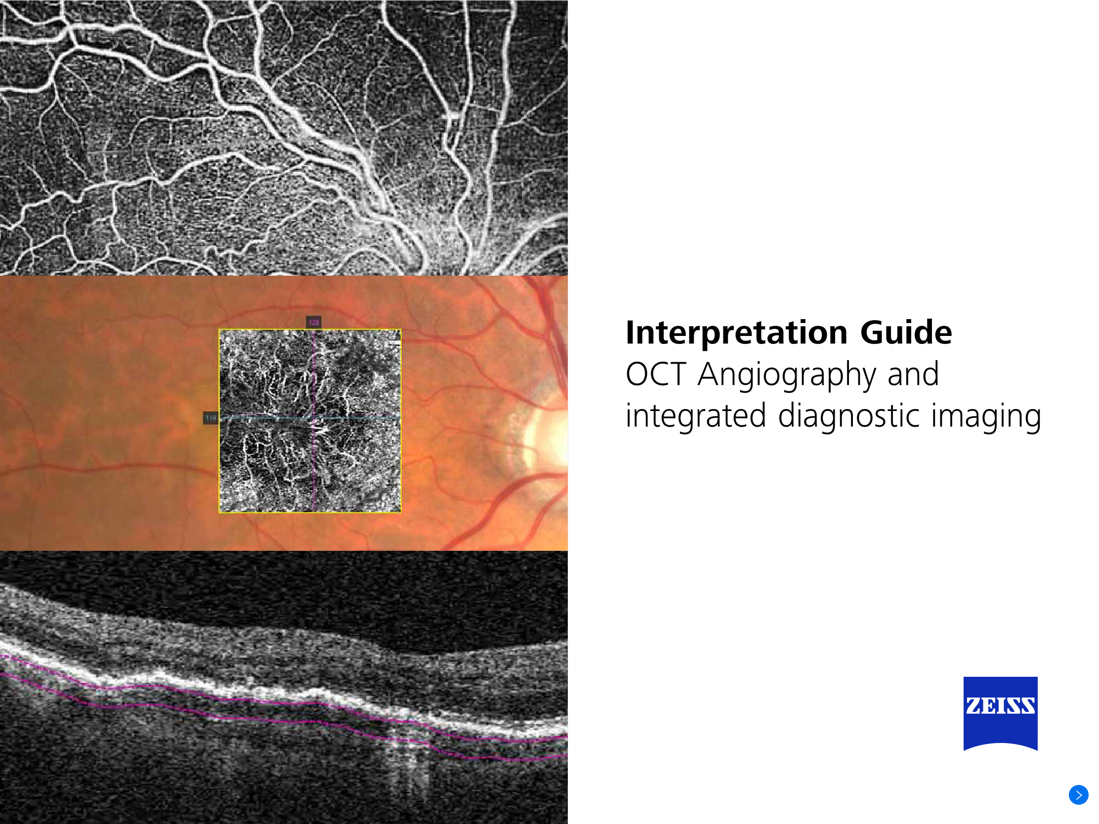 Preview image of OCT Angiography Interpretation E-Book EN